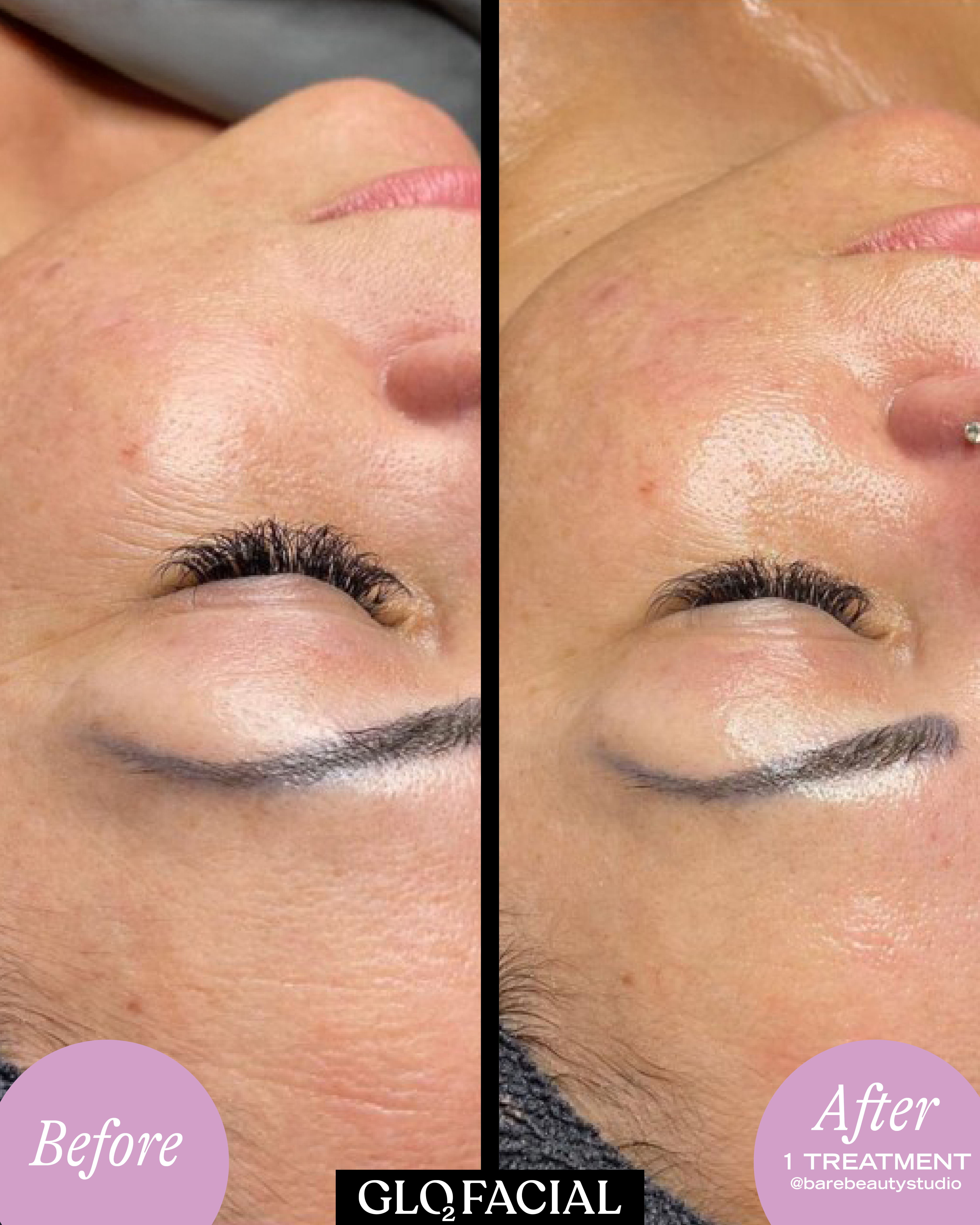 Avant après Geneo X montrant une texture de peau plus lisse