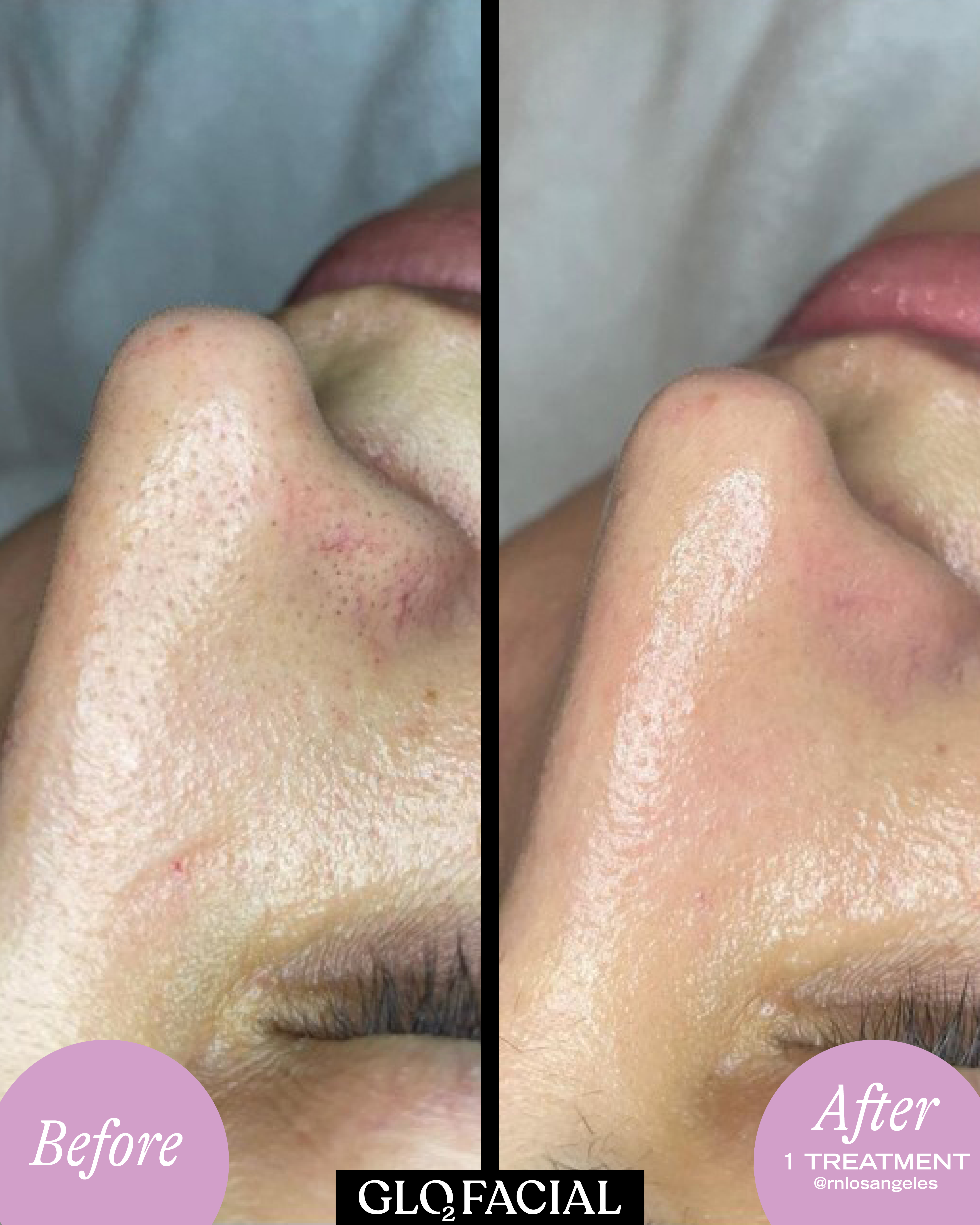 Avant après Geneo X montrant une peau plus lumineuse au niveau du nez